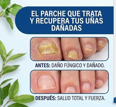 🍄 El Parche Antihongos que ayuda a recuperar uñas sanas y fuertes (Copia)